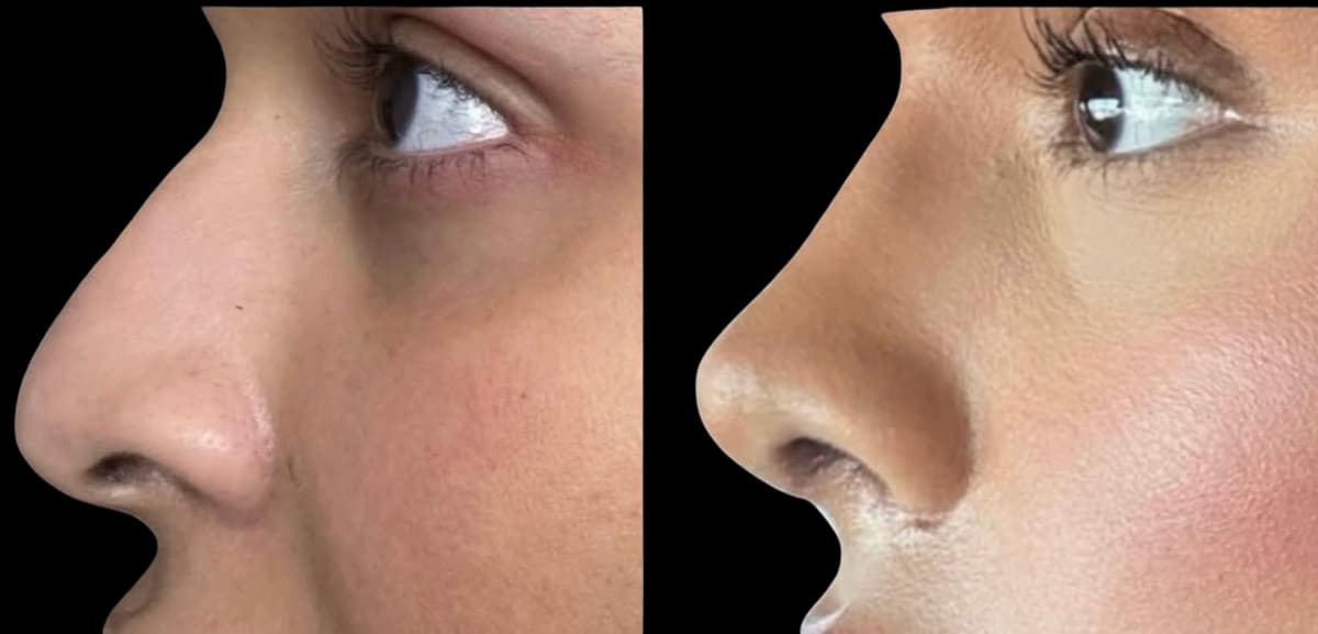 Rhinoplasty before-and-after result by Dr. Kriya Gishen